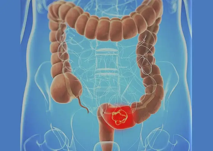 Día Mundial contra el Cáncer de Colon
