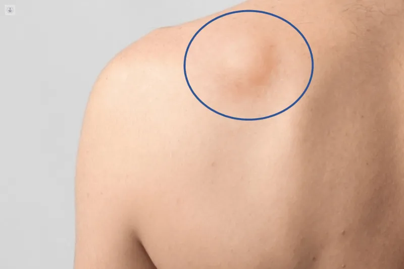 QUÉ SON LOS SARCOMAS.